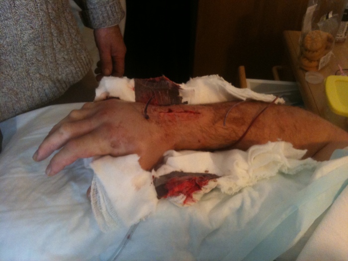 My smashed up right wrist and hand